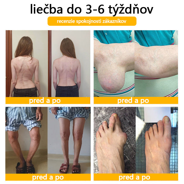 Foulme® Krém na hojenie kostí s botulotoxínom a včelím jedom ⭐👨‍⚕️