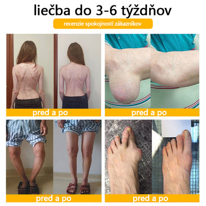 Foulme® Krém na hojenie kostí s botulotoxínom a včelím jedom ⭐👨‍⚕️