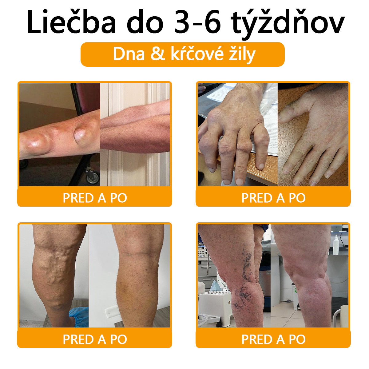 Foulme® Krém na hojenie kostí s botulotoxínom a včelím jedom ⭐👨‍⚕️