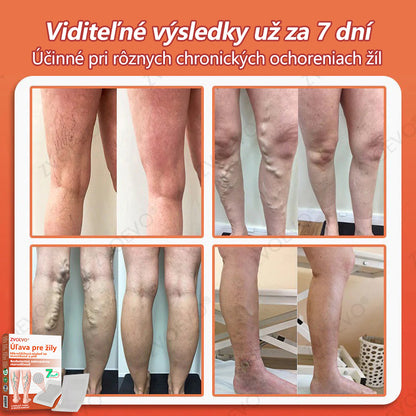 ☘️ Zvoevo® Vein Ease mikroihličková terapia (na metličkové žilky, kŕčové žily, opuchy nôh a únavu nôh)