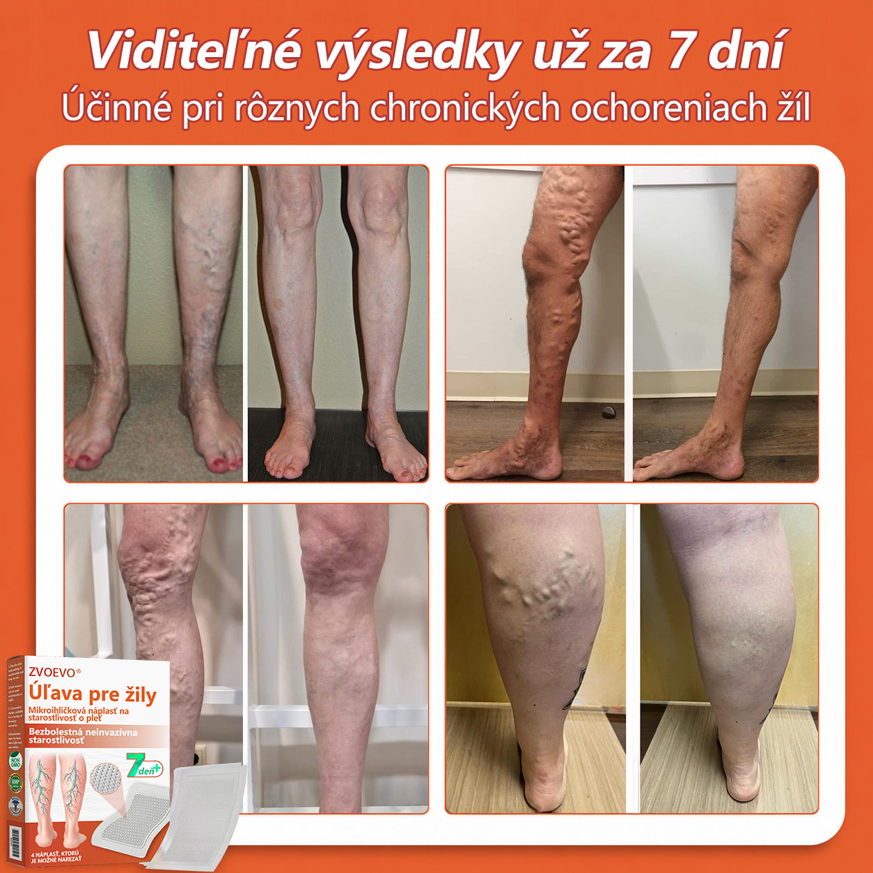 ☘️ Zvoevo® Vein Ease mikroihličková terapia (na metličkové žilky, kŕčové žily, opuchy nôh a únavu nôh)