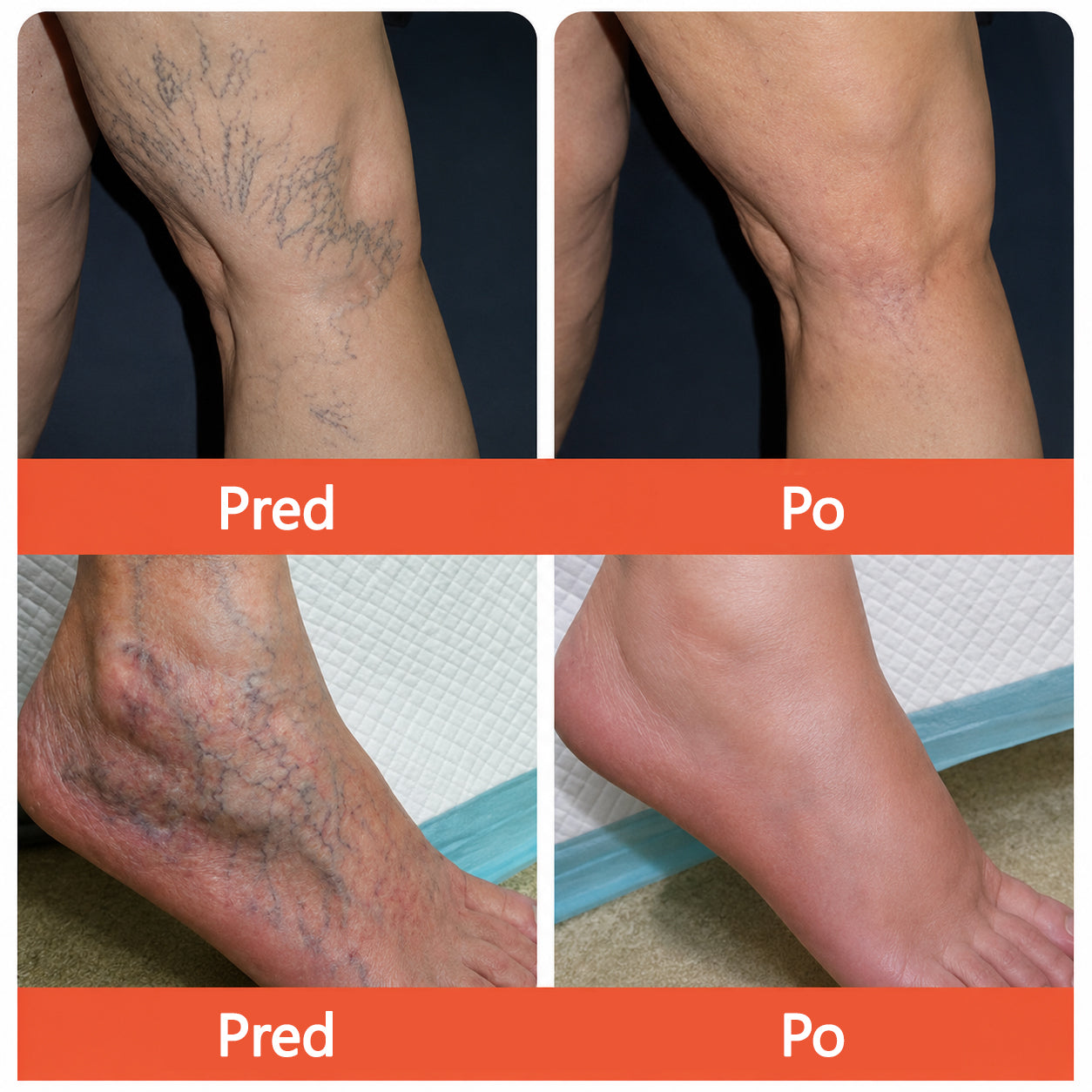 ☘️ Zvoevo® Vein Ease mikroihličková terapia (na metličkové žilky, kŕčové žily, opuchy nôh a únavu nôh)