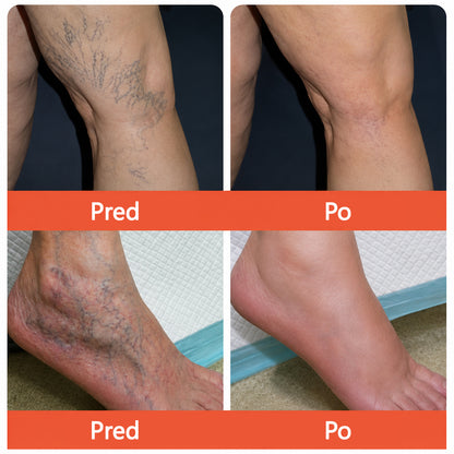 ☘️ Zvoevo® Vein Ease mikroihličková terapia (na metličkové žilky, kŕčové žily, opuchy nôh a únavu nôh)