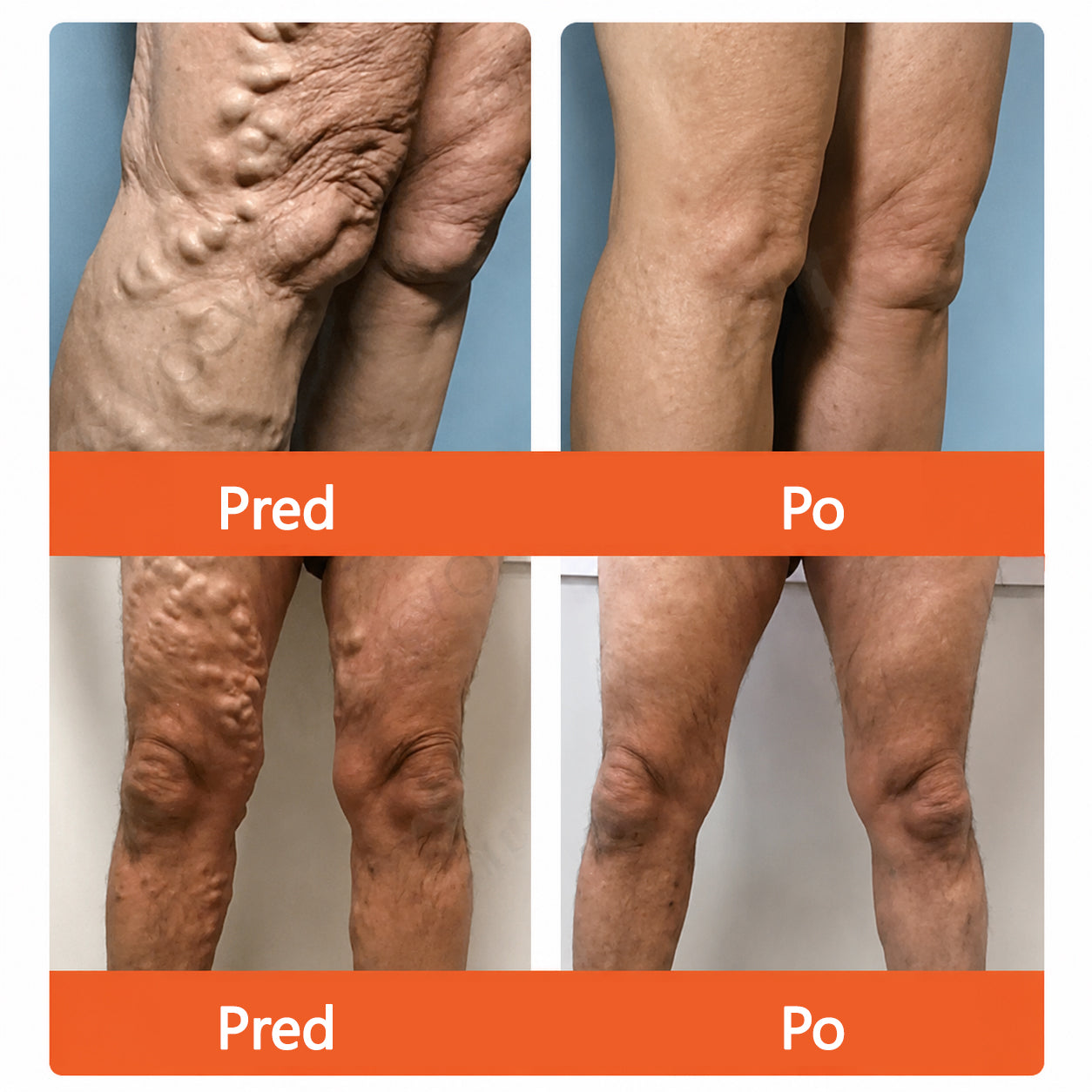 ☘️ Zvoevo® Vein Ease mikroihličková terapia (na metličkové žilky, kŕčové žily, opuchy nôh a únavu nôh)