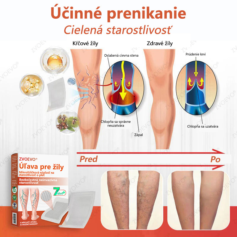 ☘️ Zvoevo® Vein Ease mikroihličková terapia (na metličkové žilky, kŕčové žily, opuchy nôh a únavu nôh)