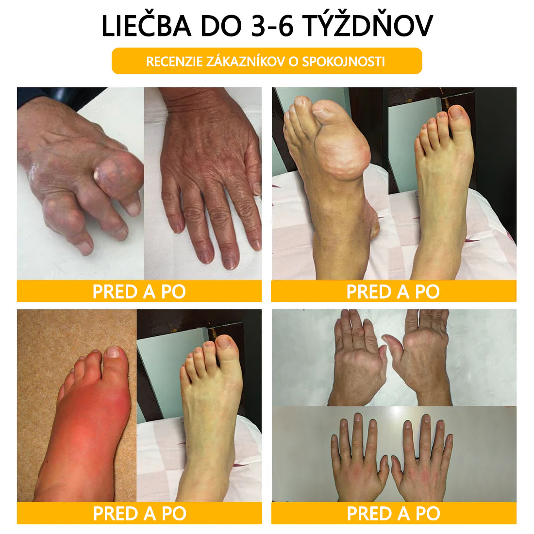 Foulme® Krém na hojenie kostí s botulotoxínom a včelím jedom ⭐👨‍⚕️