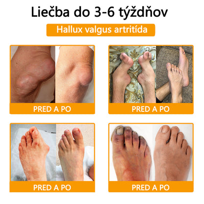 Foulme® Krém na hojenie kostí s botulotoxínom a včelím jedom ⭐👨‍⚕️